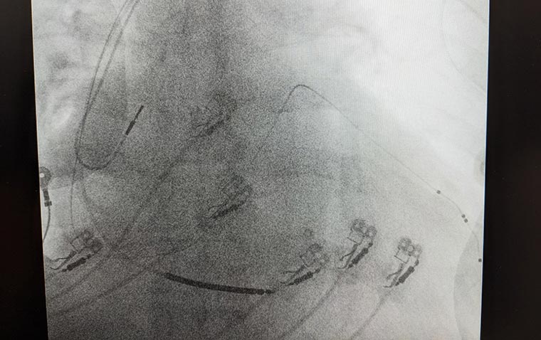 Ressincronização cardíaca (CRT)